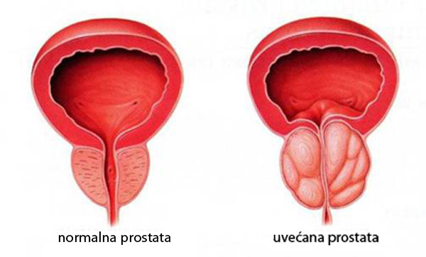 Prostata